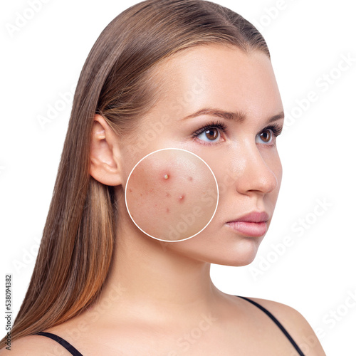 Young woman with zoom circle before and after acne treatment.