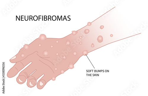 Hand with light brown spots on the skin or Neurofibroma spinal cord Freckles disease