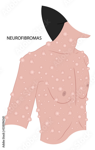 light brown spots on the skin or Neurofibroma spinal cord Freckles disease