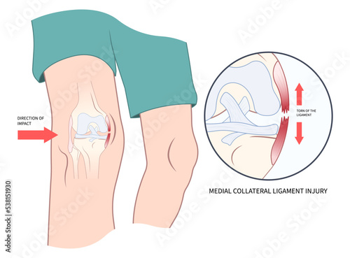Knee athletic meniscal femur Injury test Medial collateral ligament pop Grade hurt