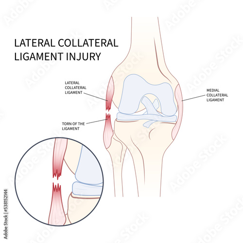 Left lateral Medial collateral ligament Injury with pop femur of athletic meniscal test Grade hurt