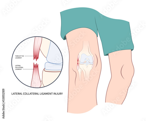 Left lateral Medial collateral ligament Injury with pop femur of athletic meniscal test Grade hurt photo