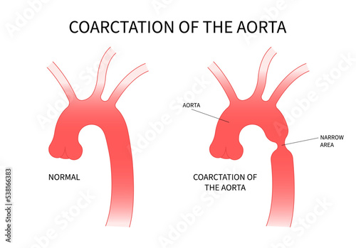 Heart coarctation of the aorta high blood pressure and Turner's disorder photo