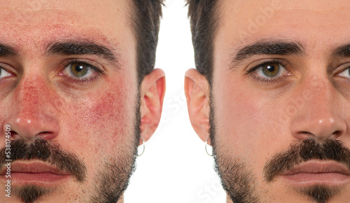 Before and after a treatment for rosacea in a man's face