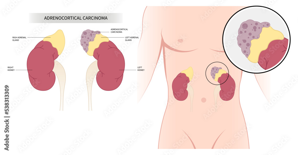 Adrenal Disorder of Addison’s or Cushing’s syndrome Adrenocortical