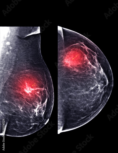  X-ray Digital Mammogram or mammography of both side breast CC view and MLO  . photo