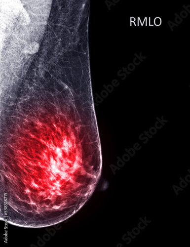 X-ray Digital Mammogram or mammography of both side breast Standard views are  mediolateral oblique (MLO) views . photo