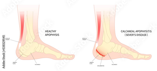 The sever's disease painful tendon tear and haglund's Flatfeet exercise Supination with Pronation obesity of trauma ankle injury broken bone photo
