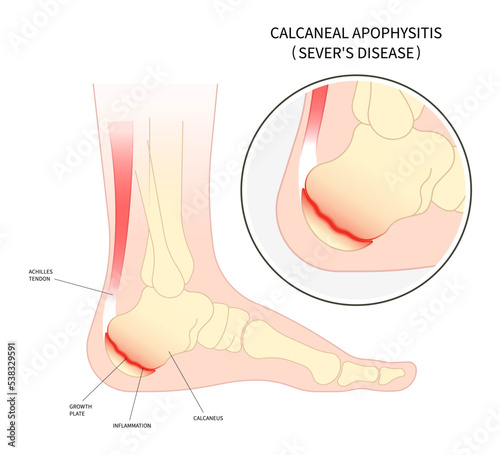 ankle injury broken bone The sever's disease painful tendon tear and haglund's Flatfeet exercise Supination with Pronation obesity of trauma photo