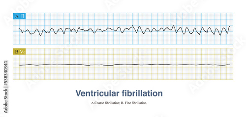 Ventricular fibrillation is a fatal arrhythmia and also a cardiac arrest rhythm. It can be divided into coarse fibrillation and fine fibrillation according to the amplitude of the fibrillation wave.