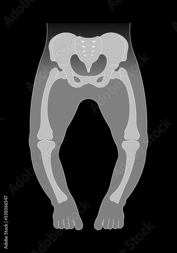 The rickets Blount's and Paget's disease of hip low density lack vitamin D with x-ray the medical anatomy