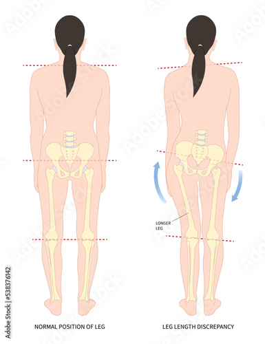 poor postural stand with toe walking ankle syndrome Unequal short leg length discrepancy tilt curvature body misaligned High pelvis femur Limb bone tilting shoulder
