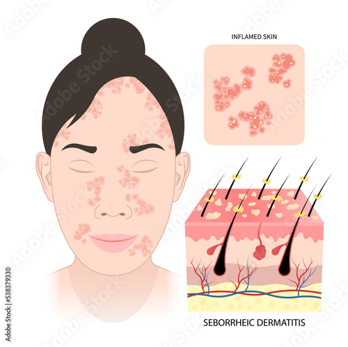 Seborrheic dermatitis on face and hair loss inflamed flake cradle cap itchy allergy shampoo health