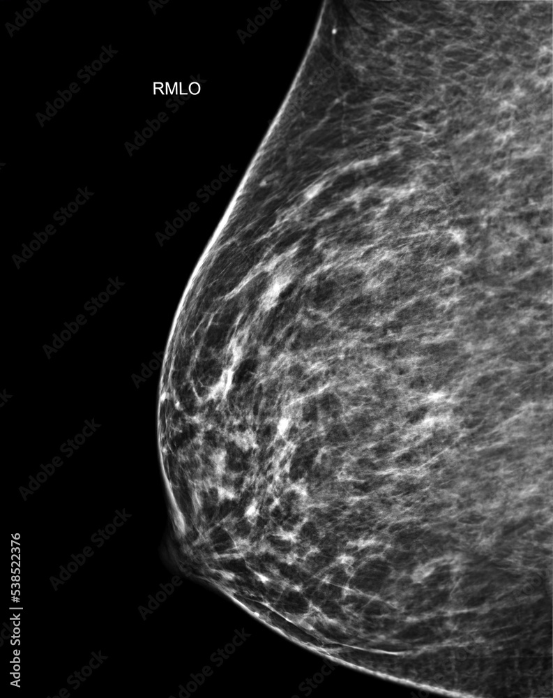 Xray Digital Mammogram or mammography of both side breast Standard