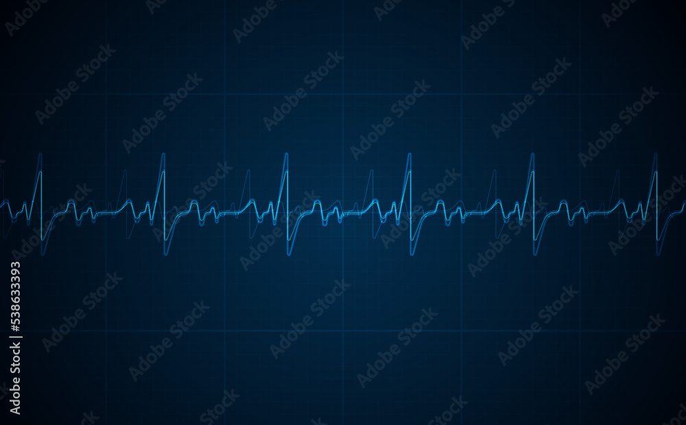 Emergency ekg monitoring. Blue glowing neon heart pulse. Heart beat. Electrocardiogram Emergency ekg monitoring. Blue glowing neon heart pulse. Heart beat. Electrocardiogram