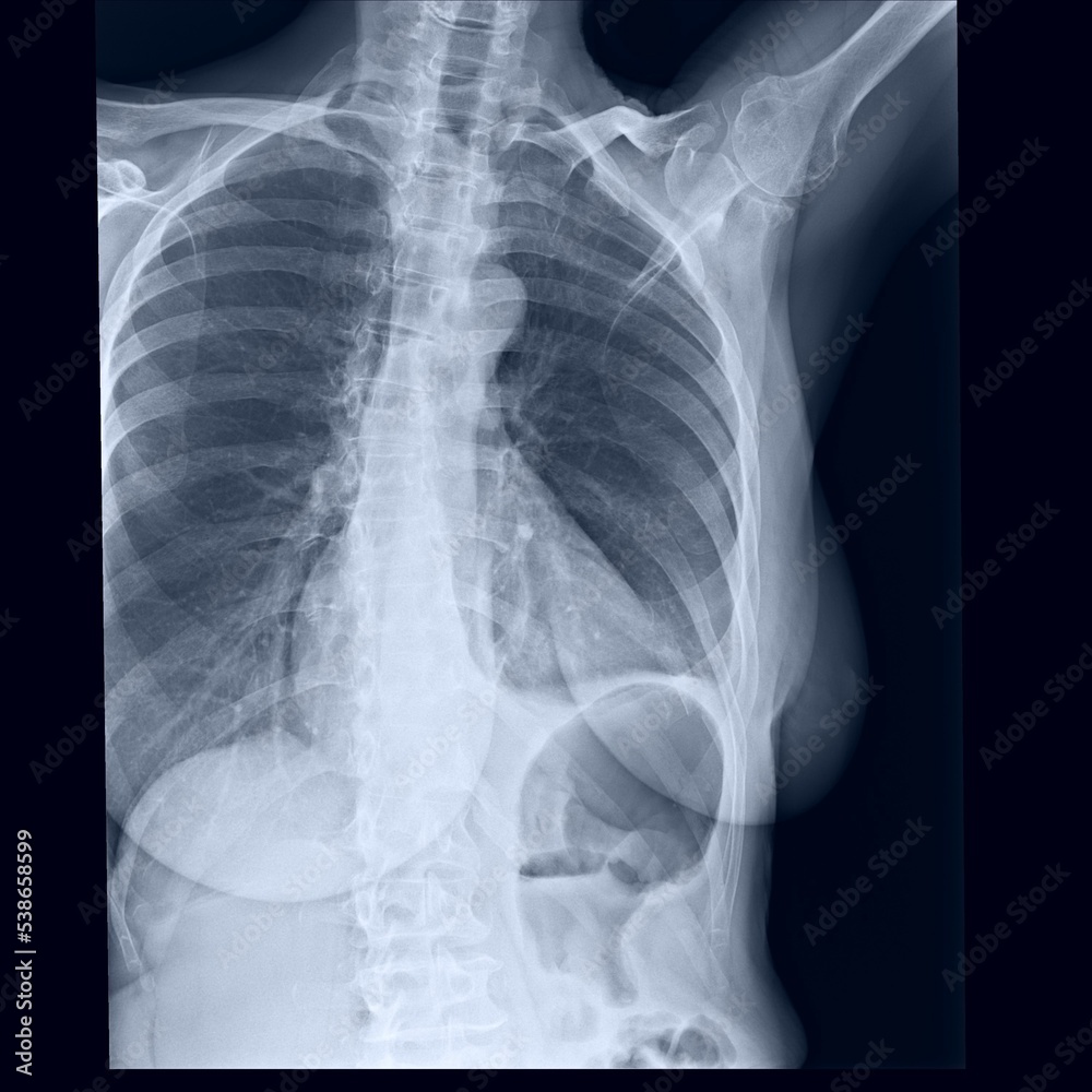 Costal x-ray of coast sternum and clavicle Costal x-ray of coast sternum and clavicle