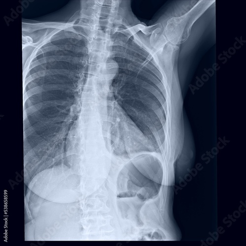 Costal x-ray of coast sternum and clavicle