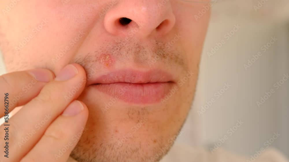 Man with herpes on lips against light grey background. Cold sore on a man lips. Sore virus concept. Man touch sore by fingers Man with herpes on lips against light grey background. Cold sore on a man lips. Sore virus concept. Man touch sore by fingers