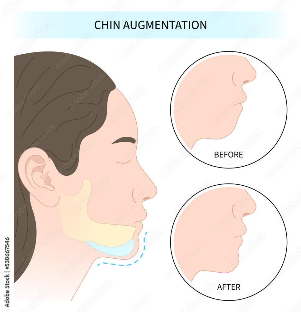 facial reshaping contour and rhytidectomy Orthodontist Temporomandibular joint Orthodontic double long Dermal chin augmentation nose grafting