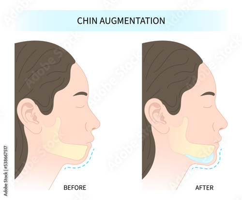 Orthodontist Temporomandibular and joint Orthodontic double long Dermal chin augmentation facial nose reshaping contour rhytidectomy grafting