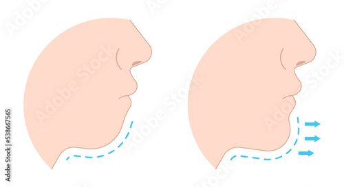 chin augmentation with rhytidectomy Orthodontist Temporomandibular joint Orthodontic double long Dermal facial nose reshaping contour grafting