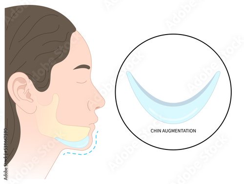 chin augmentation with rhytidectomy Orthodontist Temporomandibular joint Orthodontic double long Dermal facial nose reshaping contour grafting photo