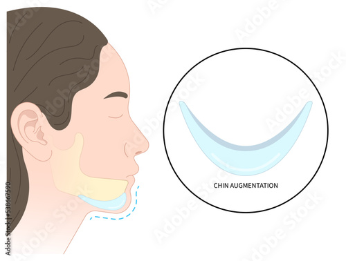 chin augmentation with rhytidectomy Orthodontist Temporomandibular joint Orthodontic double long Dermal facial nose reshaping contour grafting