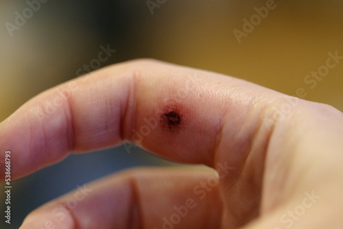 Dog bite mark on an index finger of a white woman. There is a bit swelling, redness, bruising, dry blood and beginning of a eschar. Macro medical theme photo of the wound. Closeup color image.