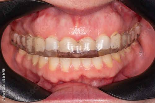 Bite splint in mouth