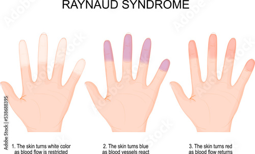 hands of a person with Raynaud's phenomenon from white color when blood flow is restricted to blue and red when blood flow returns