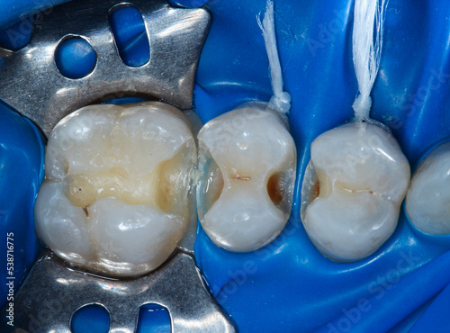 teeth cavity treatment by fillings