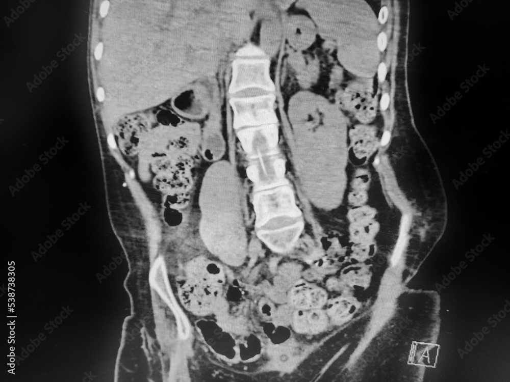 Ct abdomen constipation with stool in colon stock photo adobe stock