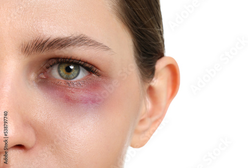 Young woman with bruise und...