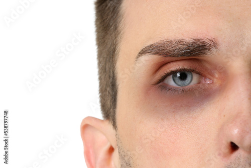 Young man with bruise under...