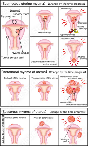 子宮筋腫の種類と時間経過　イラスト photo