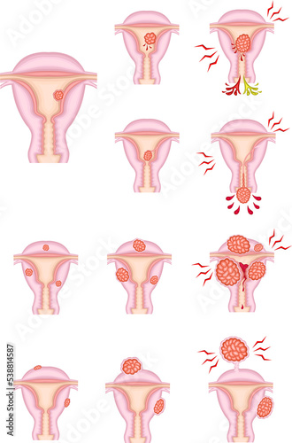 子宮筋腫の種類と時間経過　イラスト photo