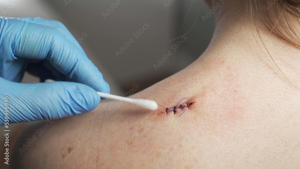 Scar from surgery. Wound scar.The scar on the shoulder.Scar with thread