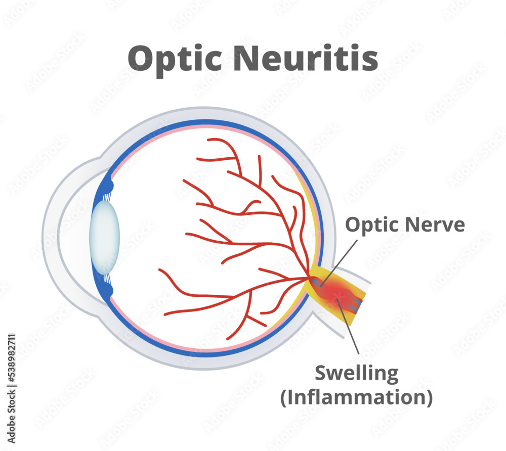 Vector medical illustration of optic neuritis isolated on white background. Nerve fibers are