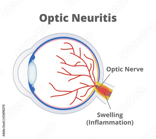 Vector medical illustration of optic neuritis isolated on white background. Nerve fibers are inflamed, and the optic nerve is swollen. Temporary vision loss and visual field loss. Eye inflammation.