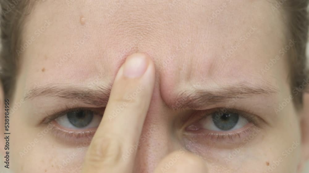 Close-up young woman eyebrow wrinkles, she is looking into camera and examining wrinkles in forehead area. Young lady feeling sad about dry aging skin.