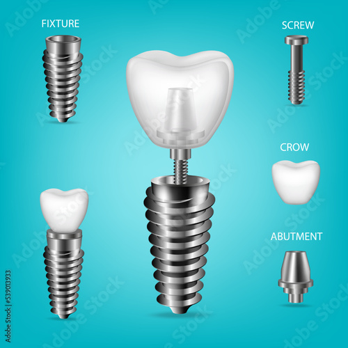Vector realistic, 3D set of dental implants. Structural elements of a dental implant, isolated.