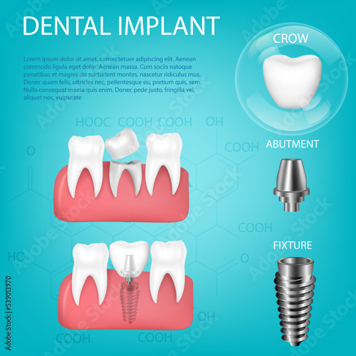 Vector realistic, 3D set of dental implants with installation in the gum. Structural elements of dental implant isolated with text.