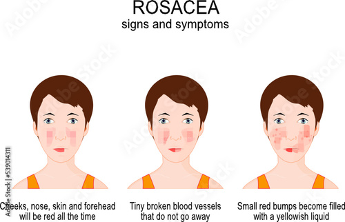 Rosacea. signs and symptoms of skin cosmetic problems