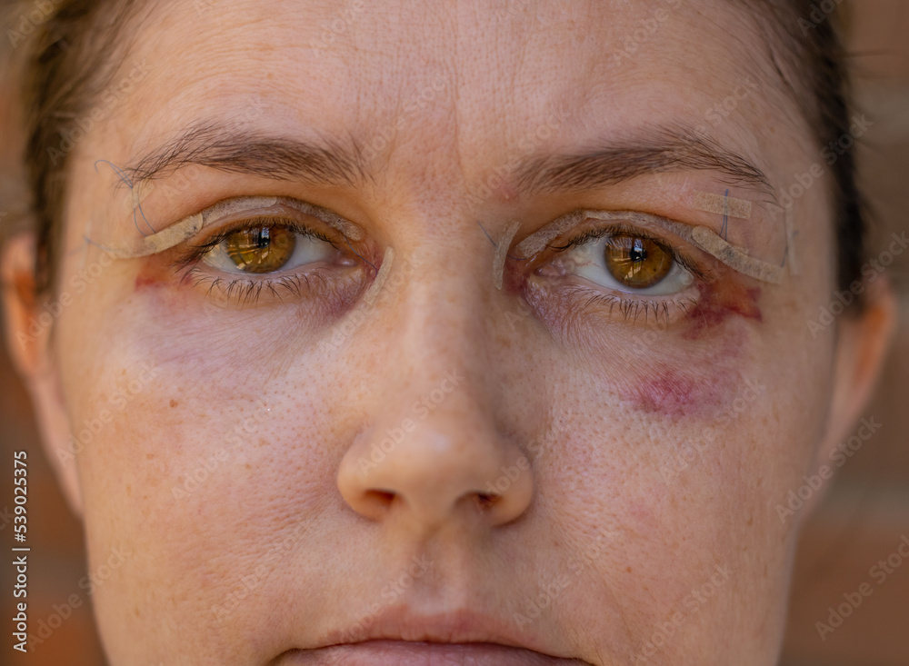 Double Eyelid Surgery, Eyes Surgery Recover Period, immediately after