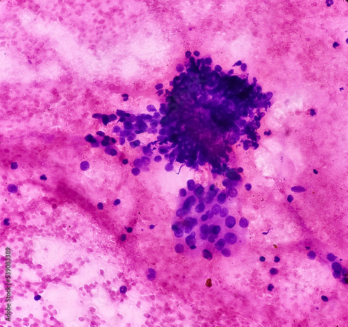 Thyroid swelling (FNA cytology): Cellular follicular lesion, microscopic image showing regular thyroid follicular epithelial cells, backgroud show histiocytes and blood. photo