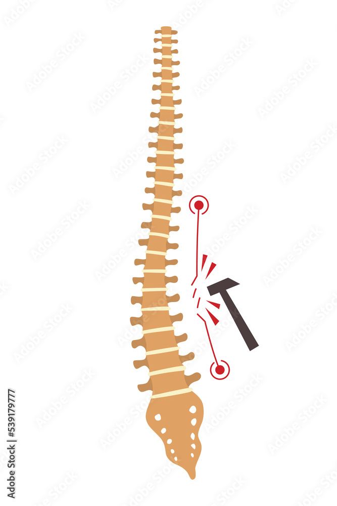 Plakat Spinal deformity. Symbol of spine curvatures or unhealthy