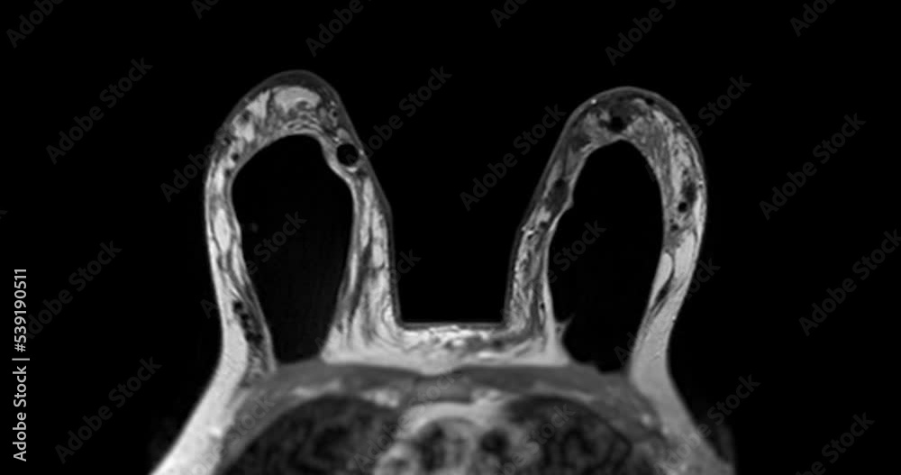 Breast Mri Magnetic Resonance Imaging Of The Breast Uses Radio Waves