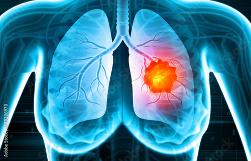Bild auf Leinwand Medical Illustration showing lung cancer or bronchial carcinoma