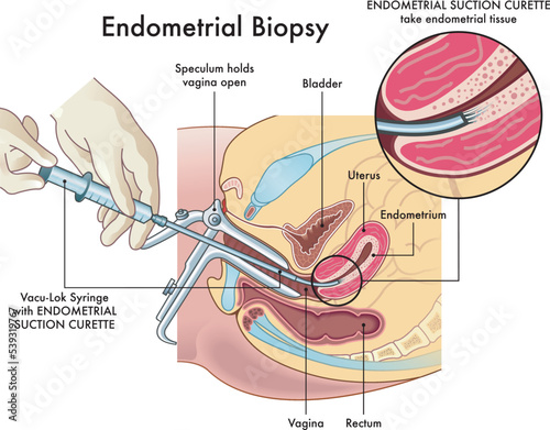 Medical illustration  of the endometrial biopsy procedure with annotations. photo