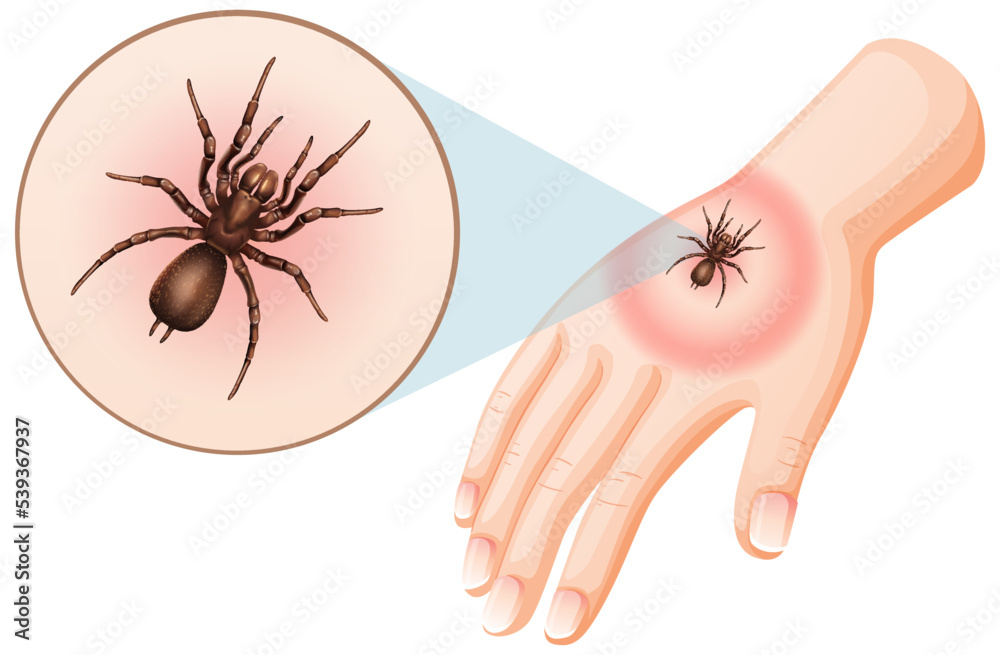 Obraz premium Spider bites sting on skin